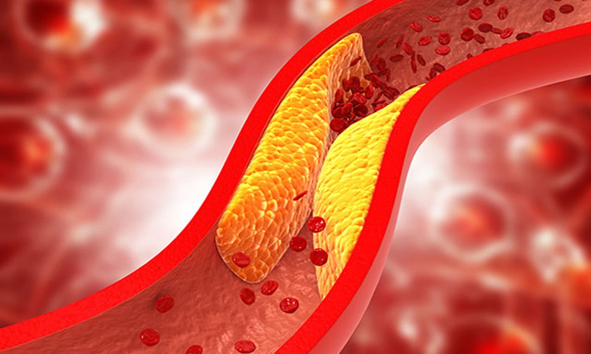 Cholesterol कम करने वाली नई कम लागत वाली वैक्स 'गेम-चेंजर'