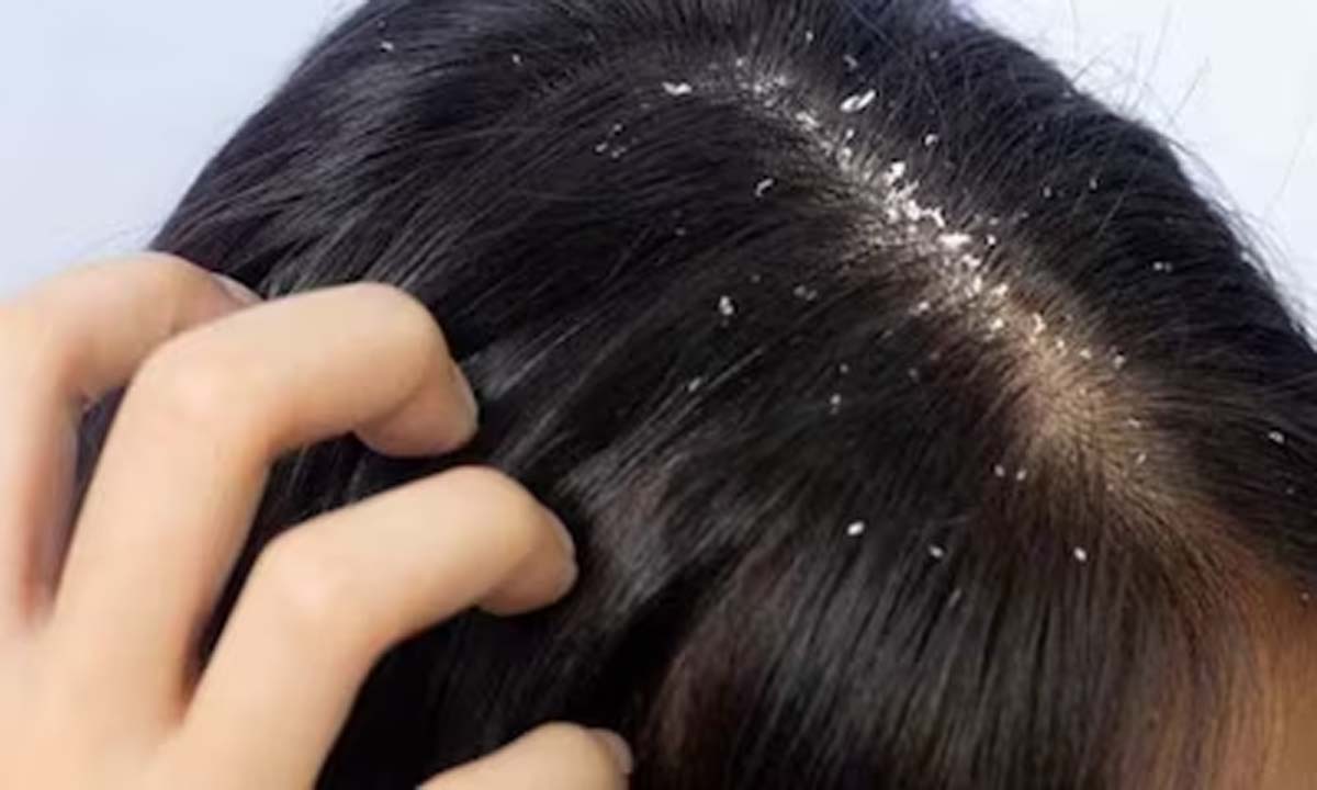 रूसी से हैं परेशान तो अपनाएं ये घरेलू नुस्खे