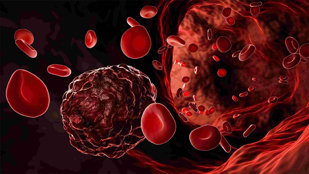 Blood Cancer: मोटे लोगों में ब्लड कैंसर होने का खतरा अधिक, स्टडी में खुलासा