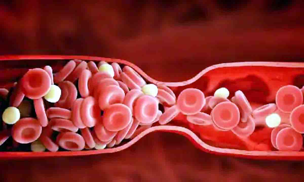 ब्लड क्लॉटिंग इससे राहत पाने के लिए अपनाएं ये 5 घरेलू उपाय
