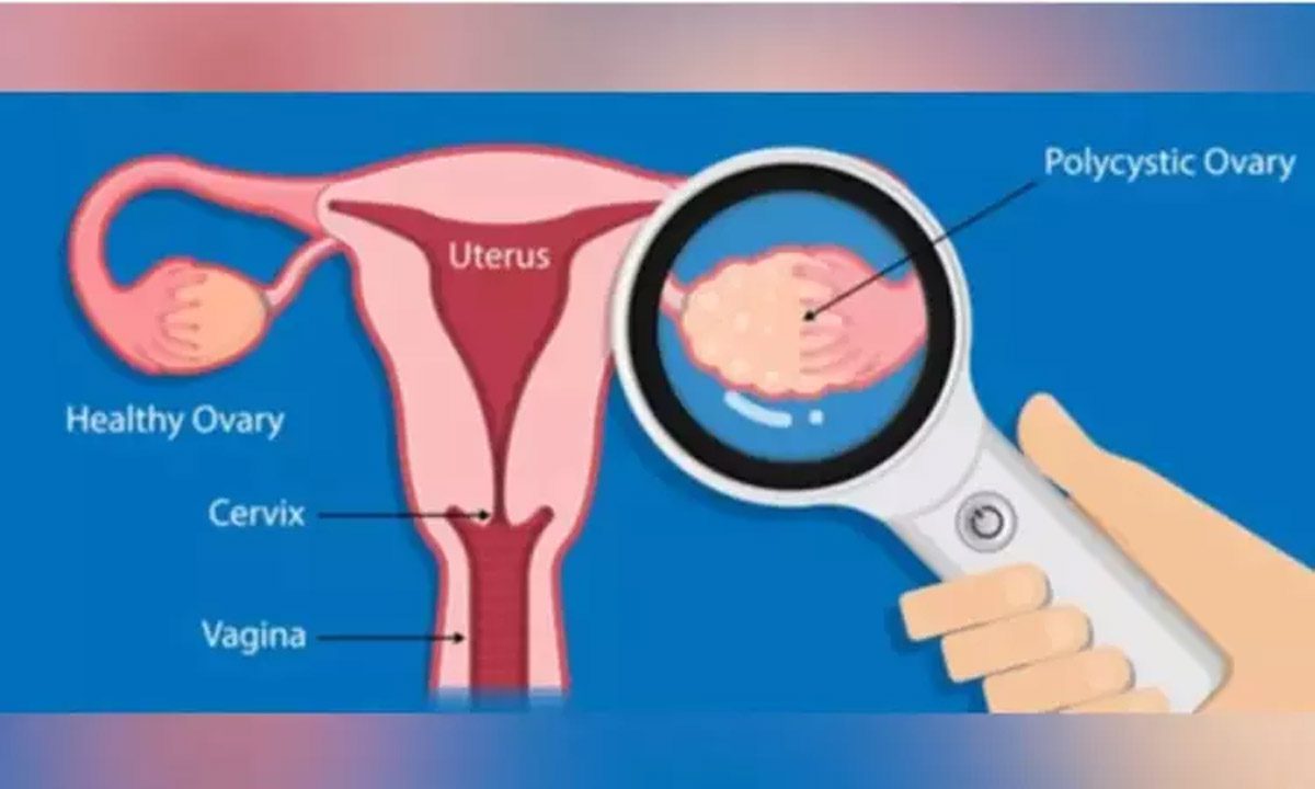 PCOS का प्रभाव महिला बांझपन से भी आगे तक फैला हुआ
